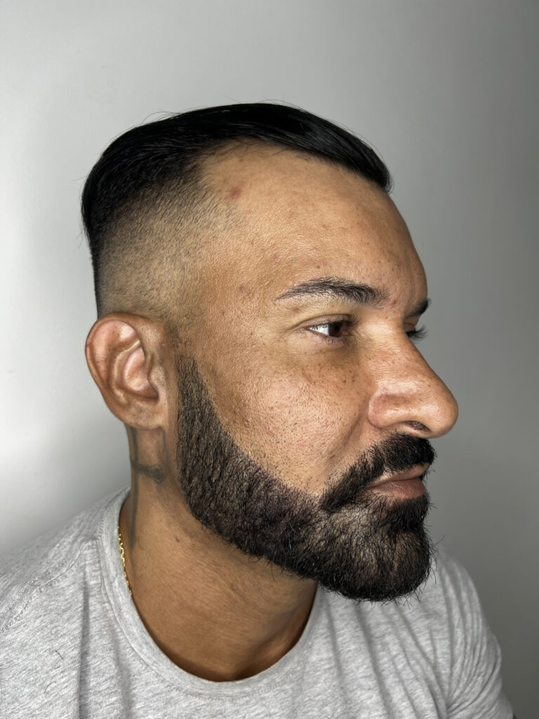 Beard Micropigmentation - Fabiano SMP